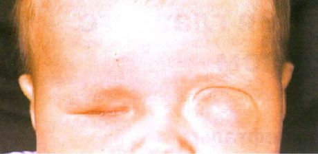 Mikrofaltums ar vienlaicīgu cistu veidošanos (kreisā acs).  Anoftalms (labā acs).