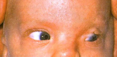 Frasera sindroms.  Nepilns kreisās acs kriptoftalmos.