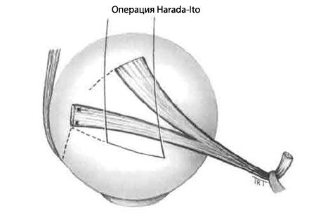 Strabisms - operācija