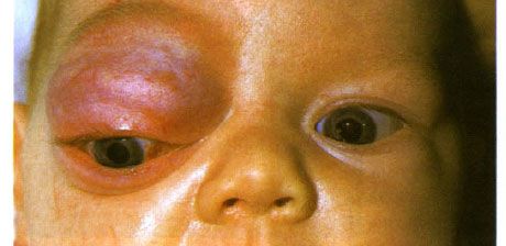 Kapilārā hemangioma no orbītas priekšējās daļas un augšējā plakstiņa.  Neoplasma tendence attīstīties