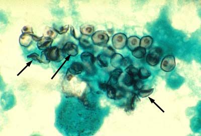 Pneimocystis (Pneumocystis jiroveci) izraisītājs