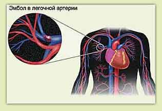 Plaušu embolija un sāpes krūtīs pa kreisi