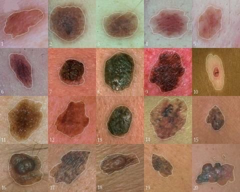 Zinātnieki ir atraduši gēnu, kuram ir galvenā loma melanomas attīstībā