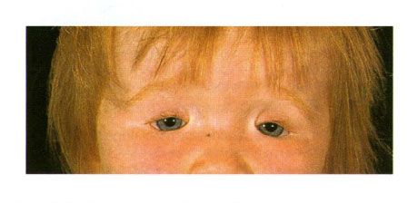 Divu pusēju plakstiņu koloboma bērnā ar Zelta sindromu.  Kreisā acs spraugas slēgšana